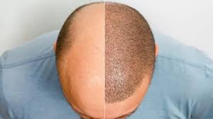 Comment retrouver confiance en soi malgré la perte de cheveux