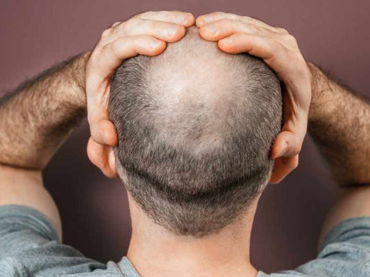 Pourquoi la calvitie n’est pas une fatalité : témoignages et solutions